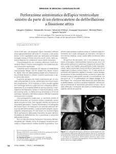 Perforazione asintomatica dell`apice ventricolare sinistro da parte di