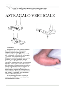 Piede valgo convesso congenito