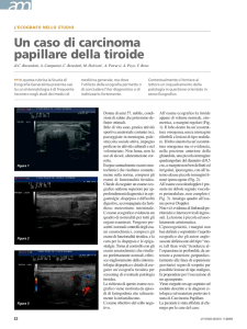 Un caso di carcinoma papillare della tiroide