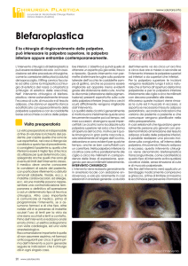 Blefaroplastica - dr. nicola freda